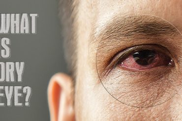 What Is Dry Eye?